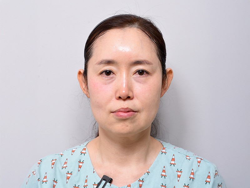 안면거상술