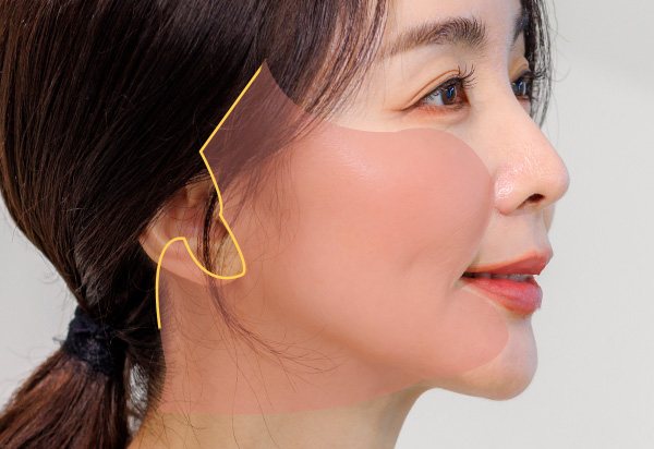 안면거상술