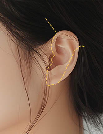 안면거상술