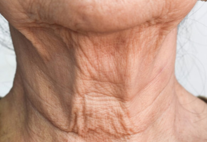Neck Lift