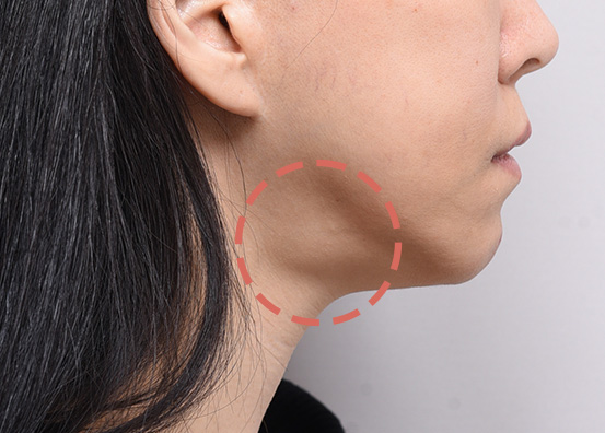  Salivary Gland Removal