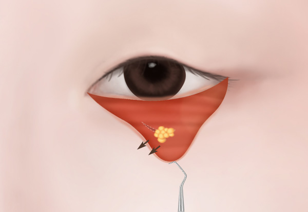 하안검수술