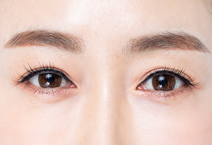 하안검수술