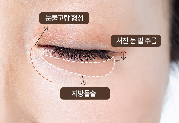 하안검수술