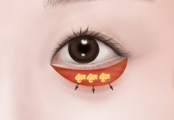 하안검수술