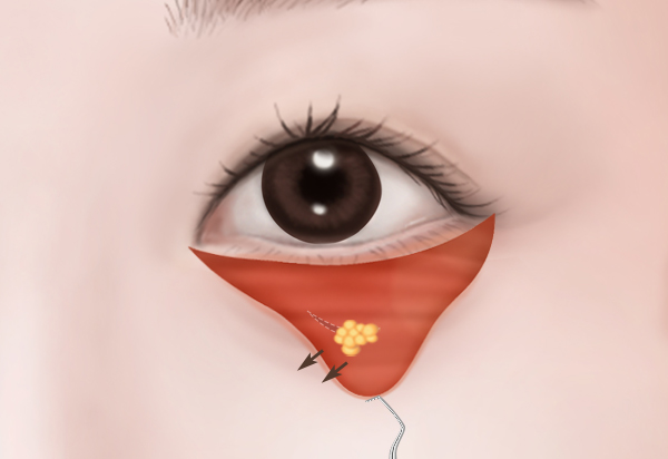 하안검수술