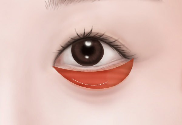 하안검수술