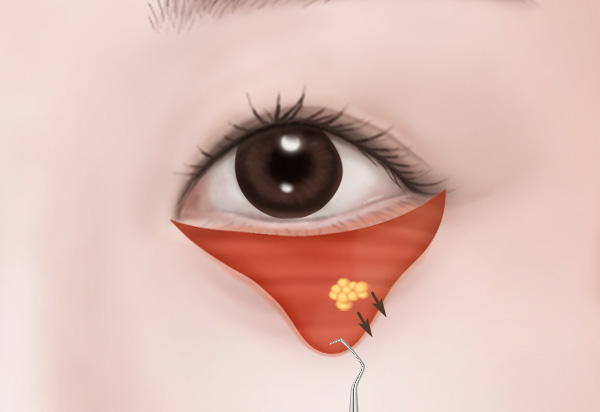 하안검수술