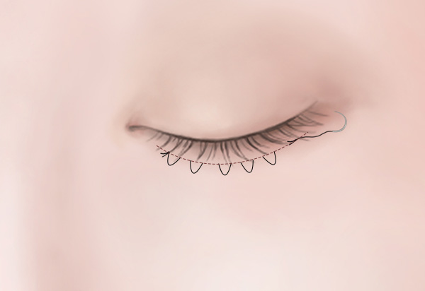 하안검수술