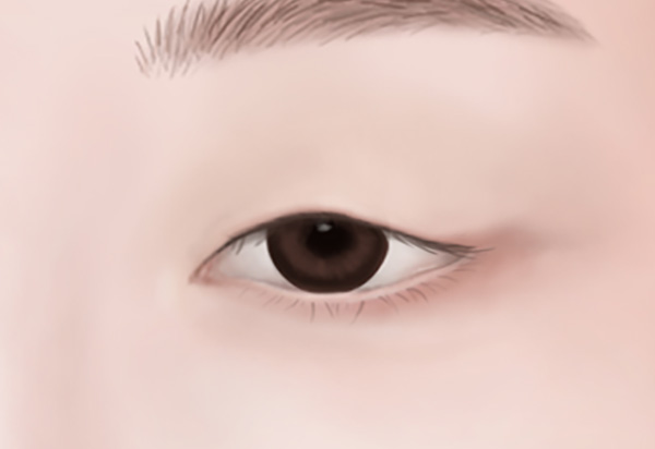 Eyebrow Lifting Surgery