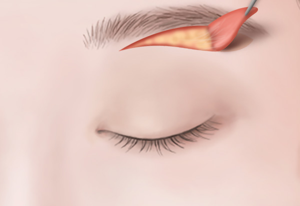 Eyebrow Lifting Surgery