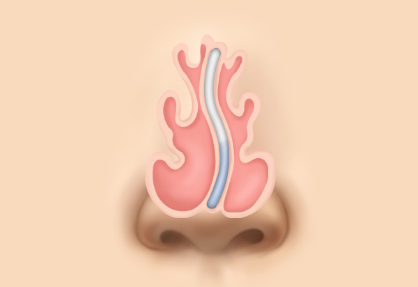 Functional Rhinoplasty