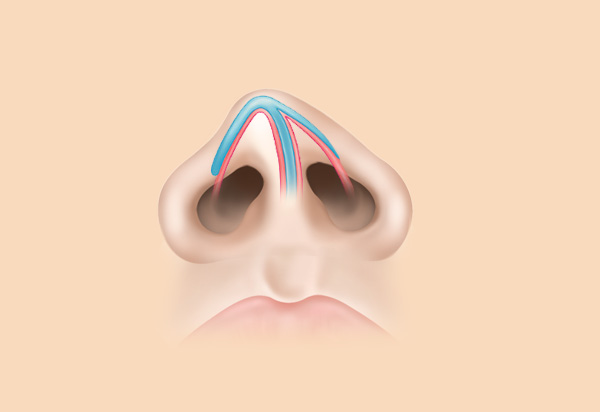 Functional Rhinoplasty