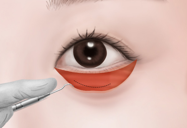 Undereye Fat Repositioning