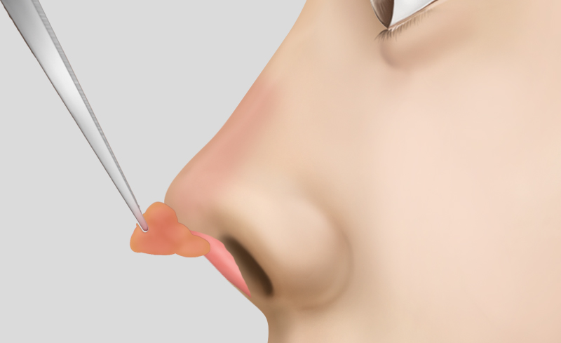 Contracted Nose Reconstruction