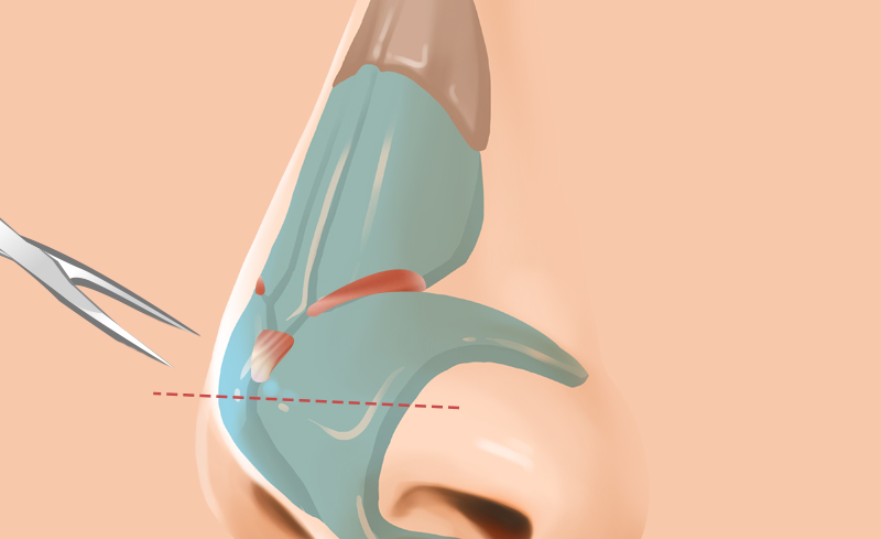 Contracted Nose Reconstruction