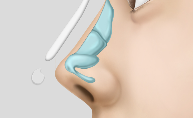 Contracted Nose Reconstruction