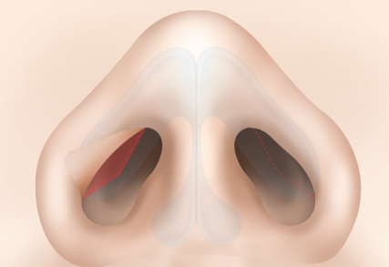Dragon Nose Rhinoplasty