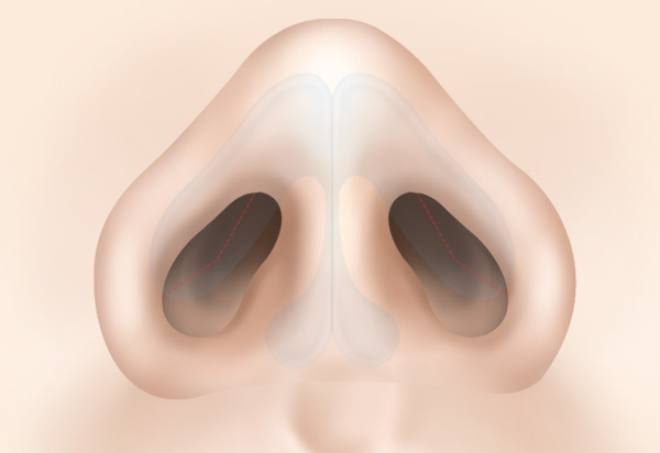 Dragon Nose Rhinoplasty