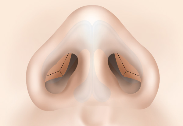 Dragon Nose Rhinoplasty