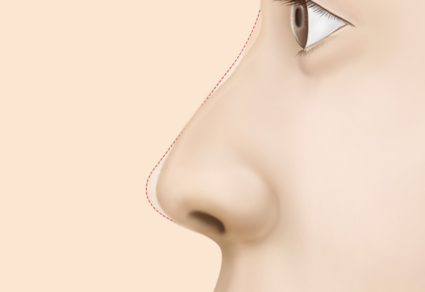 코 재수술