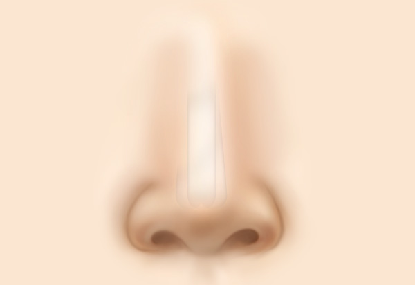 코 재수술