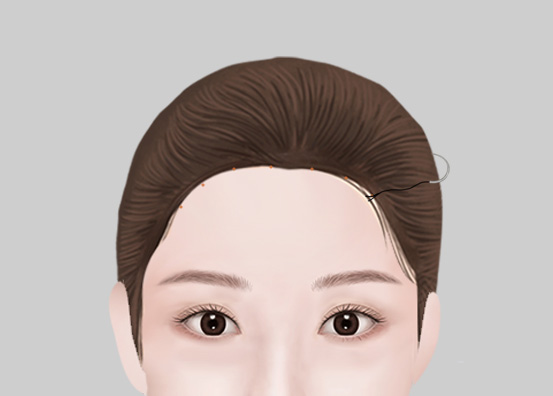 Forehead Reduction Surgery