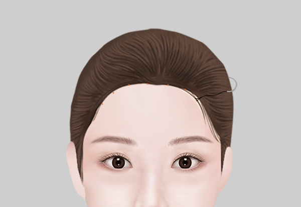 Forehead Reduction Surgery